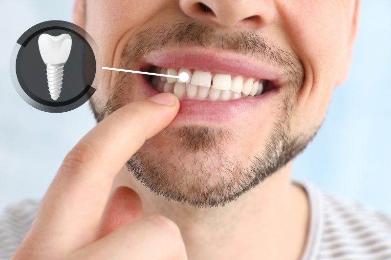 A man pointing to his loose dental implant