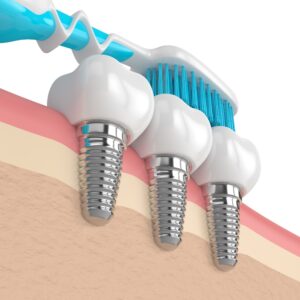 Toothbrush brushing dental implants