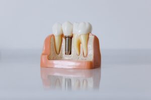 Model showing how a dental implant works